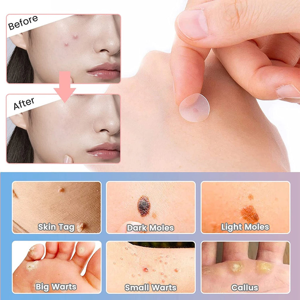 【Hot sales】72Pcs Invisible Removal Pimple Anti-Acne Hydrocolloid Patches Spots Marks Concealer Waterproof Repair Sticker