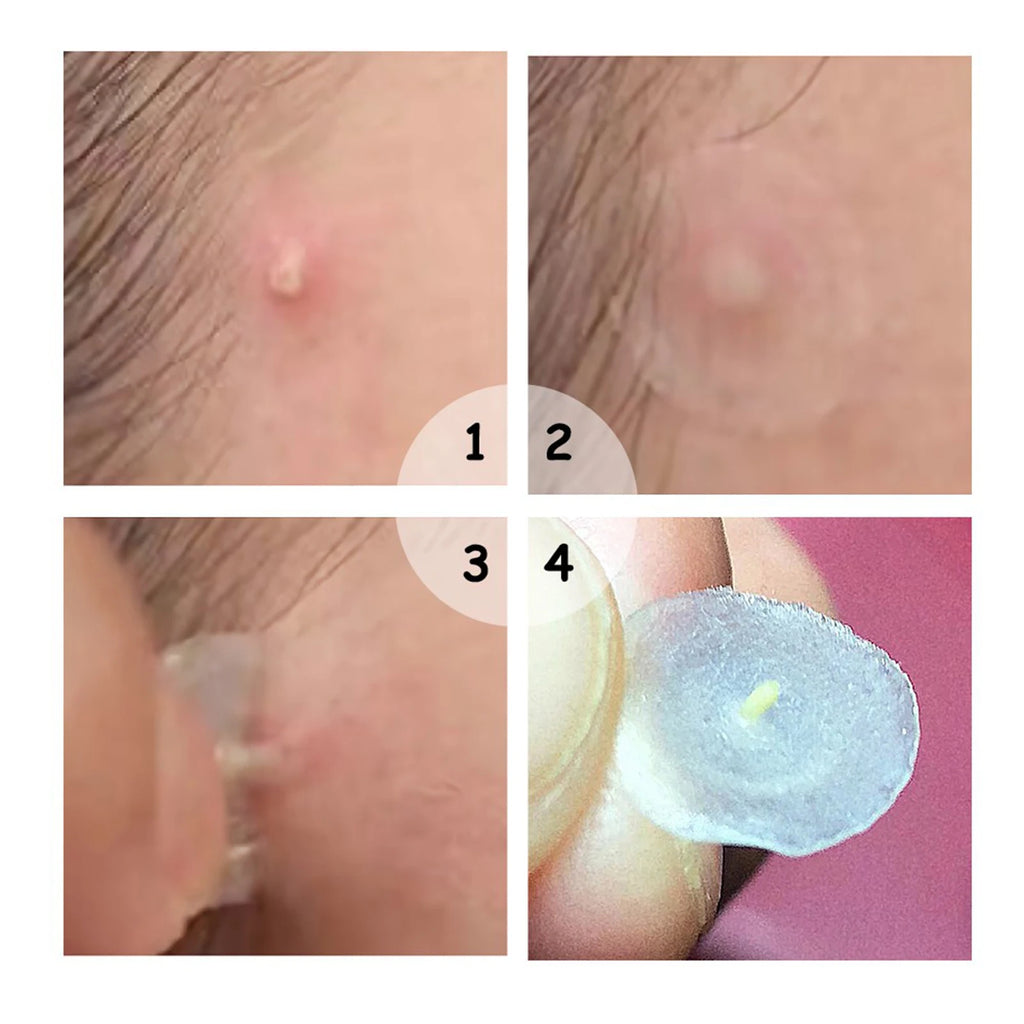 【Hot sales】72Pcs Invisible Removal Pimple Anti-Acne Hydrocolloid Patches Spots Marks Concealer Waterproof Repair Sticker